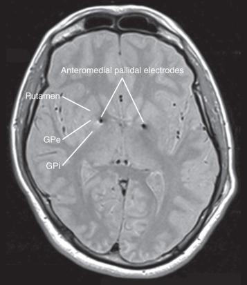 Figure 58.2, Anteromedial globus pallidus internus deep brain electrodes for Tourette syndrome demonstrated on proton density axial MRI. GPe, globus pallidus externus; GPi, globus pallidus internus.