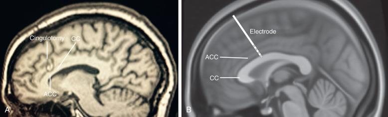 Figure 58.3, (A) Cingulotomy lesion on sagittal T1 MRI and (B) cingulate electrode schematic on Montreal Neurological Institute standard brain atlas; ACC, anterior cingulate gyrus; CC, corpus callosum.