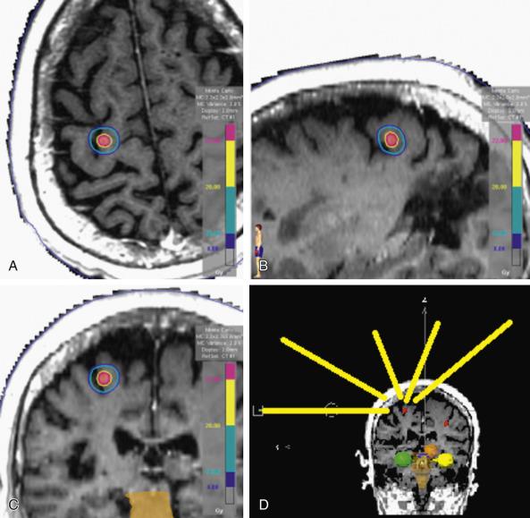 Fig. 27.1, Example of a stereotactic radiosurgery treatment of a right parietal lesion to a prescription dose of 20 Gy, illustrating good conformality. The target is outlined in red and shaded in pink. The 20-Gy prescription isodose volume is outlined in yellow and is shown on (A) axial, (B) sagittal, and (C) coronal planes through the center of the lesion, in all views tightly surrounding the target. The treatment was delivered on a linear accelerator; (D) is a coronal view showing the angles through which the arcs passed (yellow lines) . The beam angles were achieved by table rotations. A separately treated left-sided lesion is also seen in red in that panel, and several normal tissue structures are also outlined.