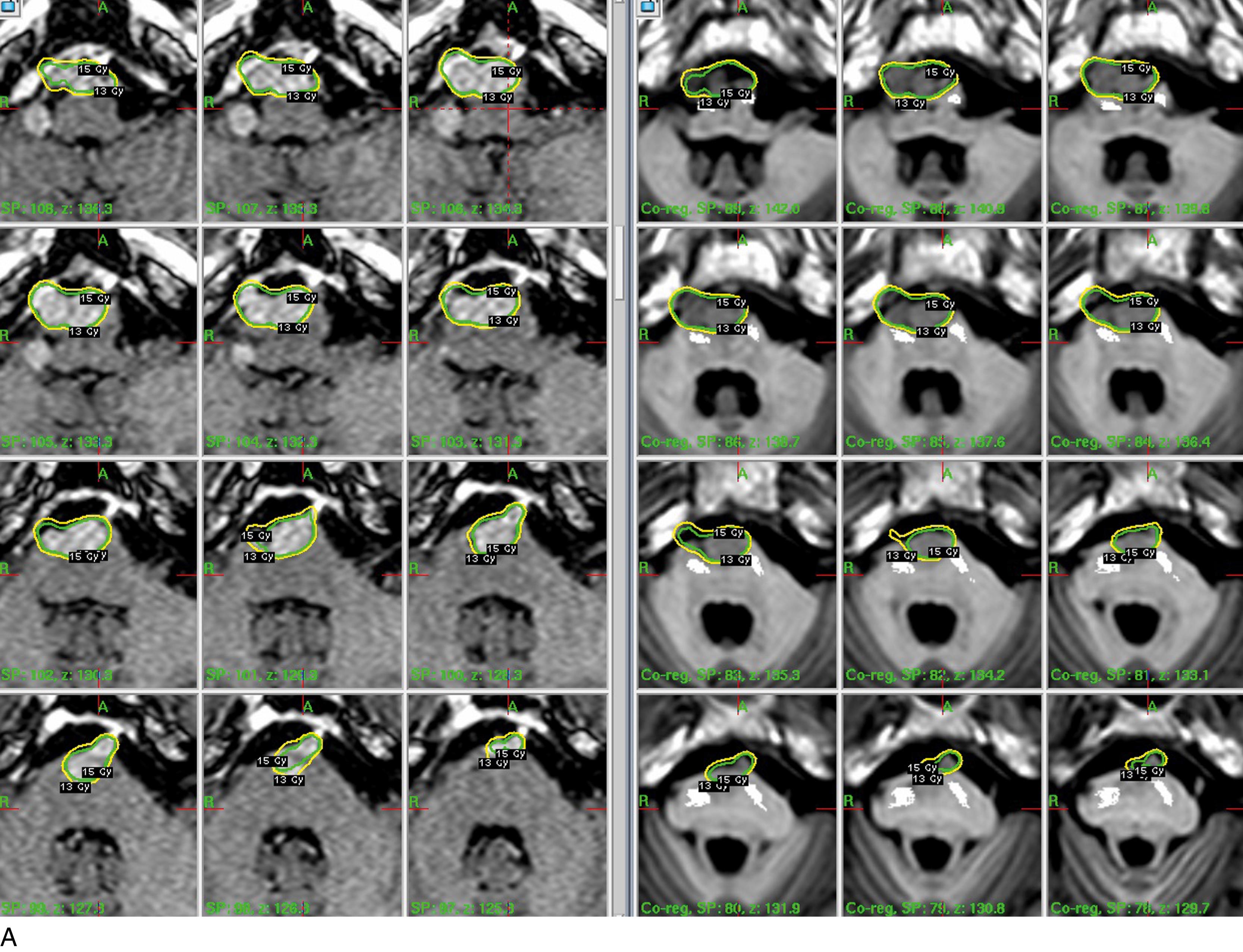 FIGURE 95.2, Cortico-spinal tract reconstruction with diffuse tensor image algorithm and its registration on gamma plan: axial (A) and coronal (B) views.