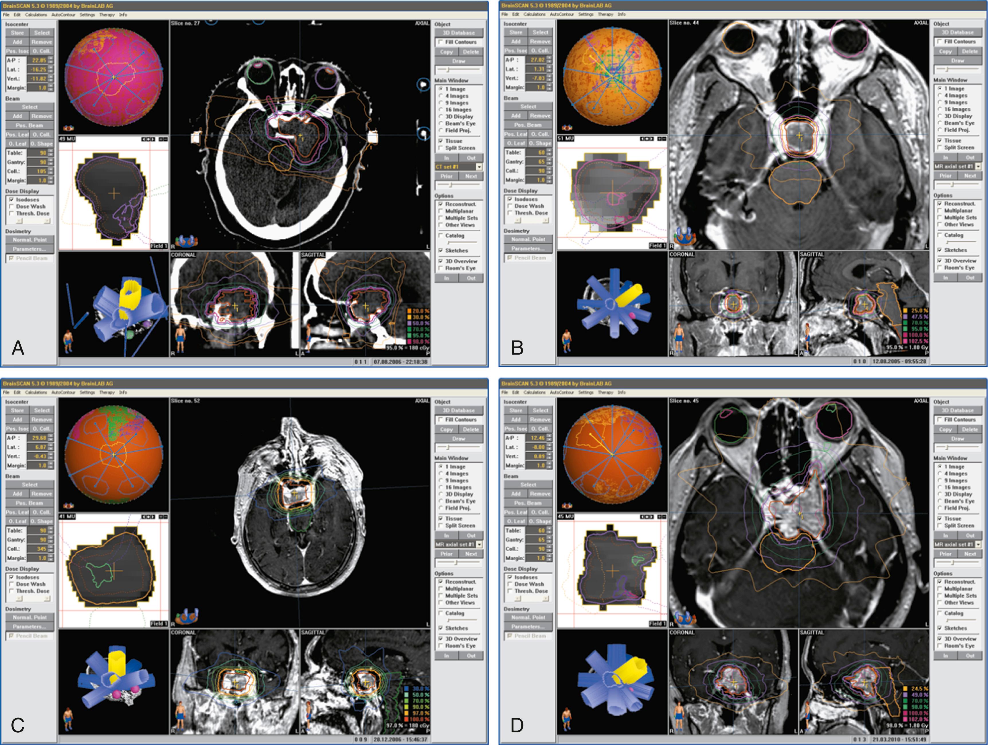 FIGURE 91.1, Image-guided radiosurgical planning for pituitary adenomas. (A) A 53-year-old woman presenting with worsening headaches and galactorrhea was found to have a 3.5-cm prolactinoma with left cavernous sinus extension. After subtotal transcranial resection, she received 25 Gy to the residual tumor, which successfully induced biochemical remission. (B) A 39-year-old man presenting with acromegaly and a 1.5-cm growth hormone–secreting adenoma. After subtotal transsphenoidal resection, he received 18 Gy and experienced hypopituitarism and a moderate decrease in IGF-1, still necessitating medical therapy. (C) An 81-year-old man presenting with a 1.6-cm nonfunctional pituitary adenoma treated with 16 Gy after subtotal resection. He has intact visual function without tumor progression or hypopituitarism. (D) A 72-year-old man with a 3-cm NFPA with suprasellar and cavernous sinus extension and recurrence after multiple surgeries. He was treated with fractionated stereotactic radiosurgery (50.4 Gy over 28 fractions) due to proximity to the optic chiasm; this was successful in halting tumor progression but complicated by a decline in visual function and a sellar hematoma postradiation.