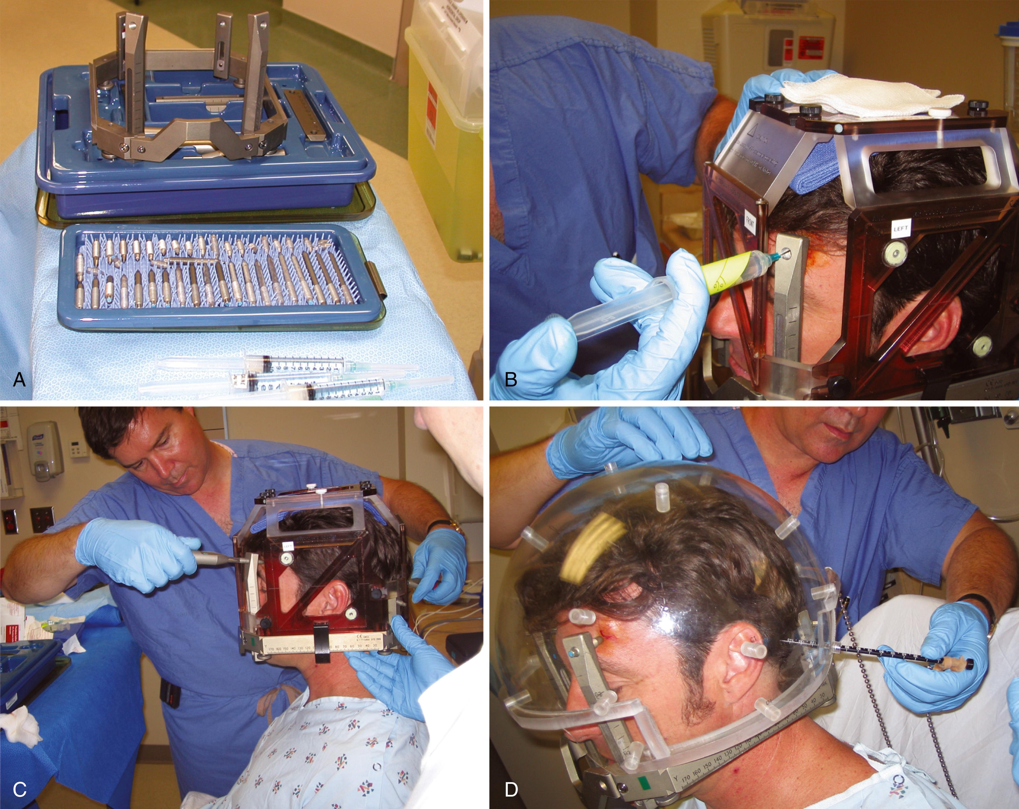 Fig. 59.7, (A) A stereotactic headframe at the time of assembly. The ins used for fixation before imaging, treatment planning, and Gamma Knife radiosurgery are seen in the foreground. (B) With a towel placed on the vertex of the head, the MRI fiducial box is balanced on the head while topical anesthetic is infiltrated at the pin sites. (C) While the headframe and attached plastic MRI fiducial box is secured to the skull using the pins, an assistant stabilizes the assembly in place. Note the tightening of the pins in opposing vectors. (D) After the frame has been secured to the skull, measurements are taken through defined entrance points in a plastic dome representing the size and position of the collimator helmet relative to the frame, head, and face. These values are incorporated into the treatment planning software to create a wire grid representing the patient’s head. The post height and pin length are also measured and are put into the treatment planning software. These values are used in the calculations used to predict collisions between the collimator helmet and the stereotactic headframe.