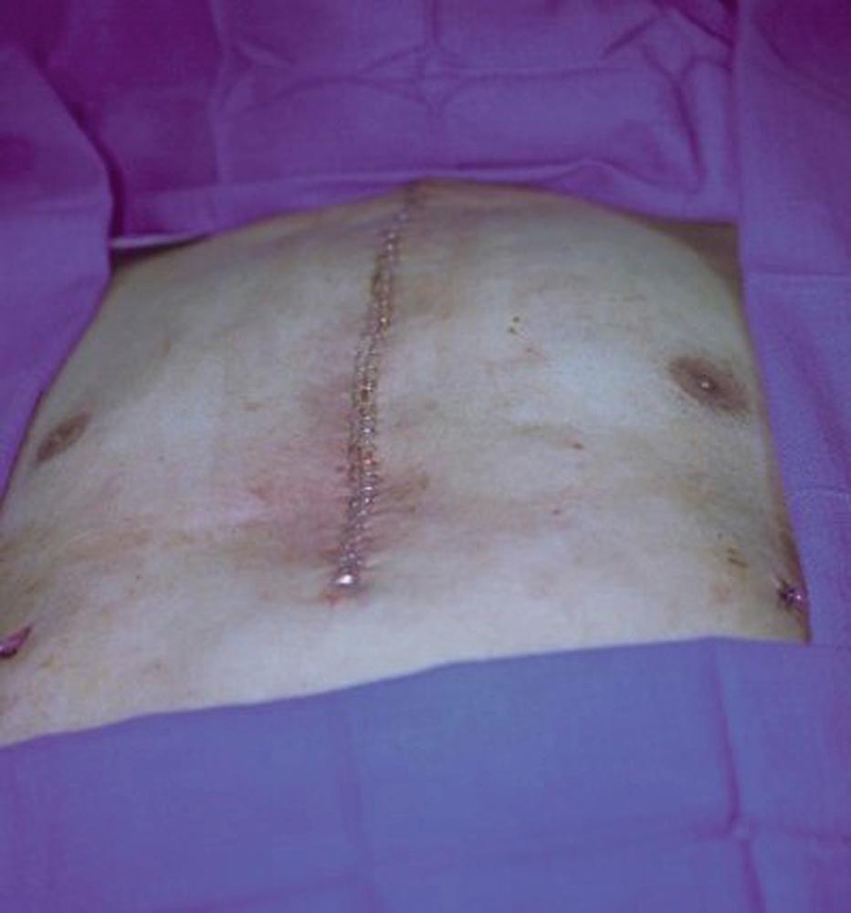 Fig. 21.4, Intraoperative view showing the final appearance after bilateral pectoral major myocutaneous advancement flap for this sternal wound closure.