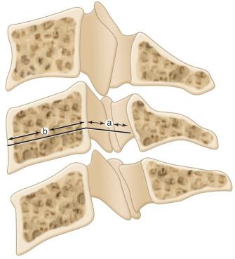 Fig. 127.2, The ratio method defined by Torg and colleagues uses a cervical spine lateral radiograph to predict an athlete's risk of sustaining a stinger. The Torg ratio is defined as the canal diameter (a) divided by the vertebral body diameter (b) .