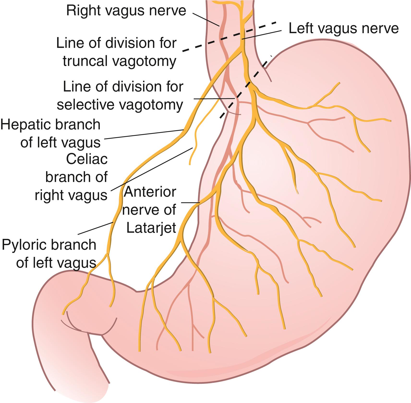 Fig. 49.4, Vagal innervation of the stomach. The line of division for truncal vagotomy is shown; it is above the hepatic and celiac branches of the left and right vagus nerves, respectively. The line of division for selective vagotomy is shown; this is below the hepatic and celiac branches.