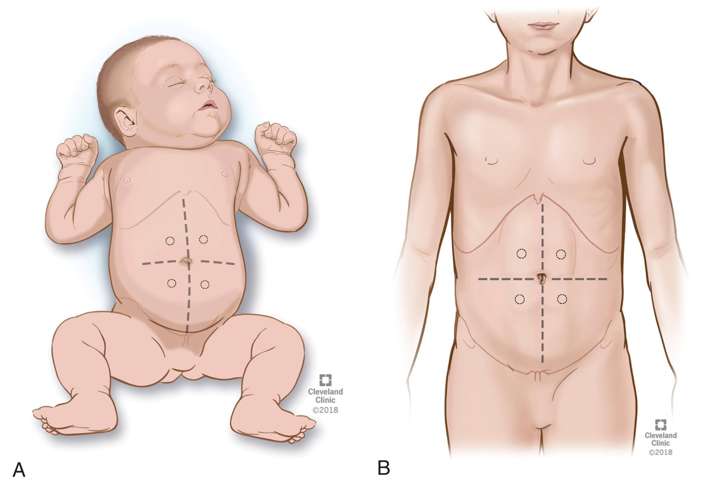 Fig. 59.1, Stoma site selection in an infant (A) and child (B). Note optimal placement within the rectus muscle and far away from the umbilicus, scars, and bony prominences. (Reprinted with permission, Cleveland Clinic Center for Medical Art & Photography © 2018. All Rights Reserved.)