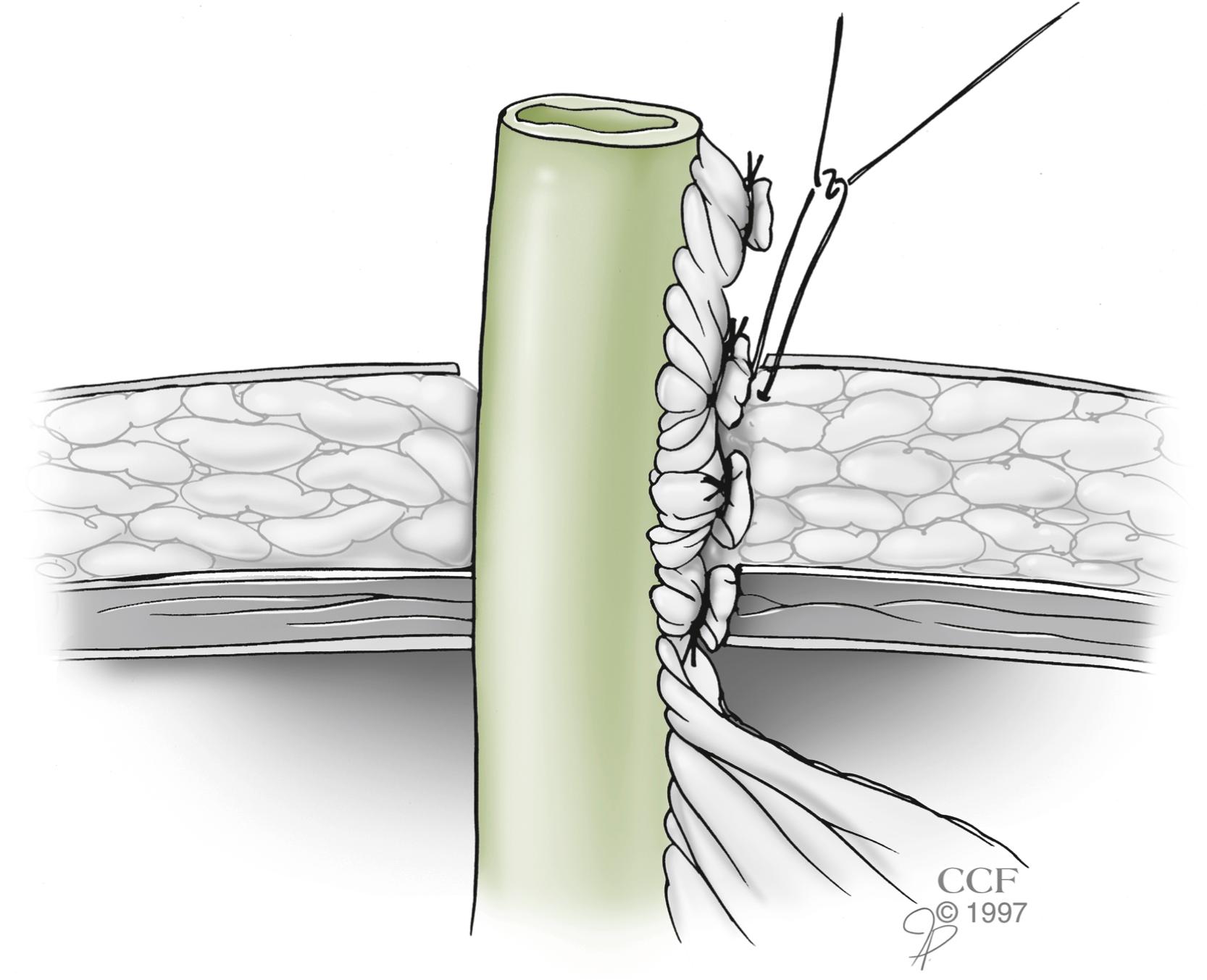 Fig. 59.2, End Ileostomy Before Maturation.