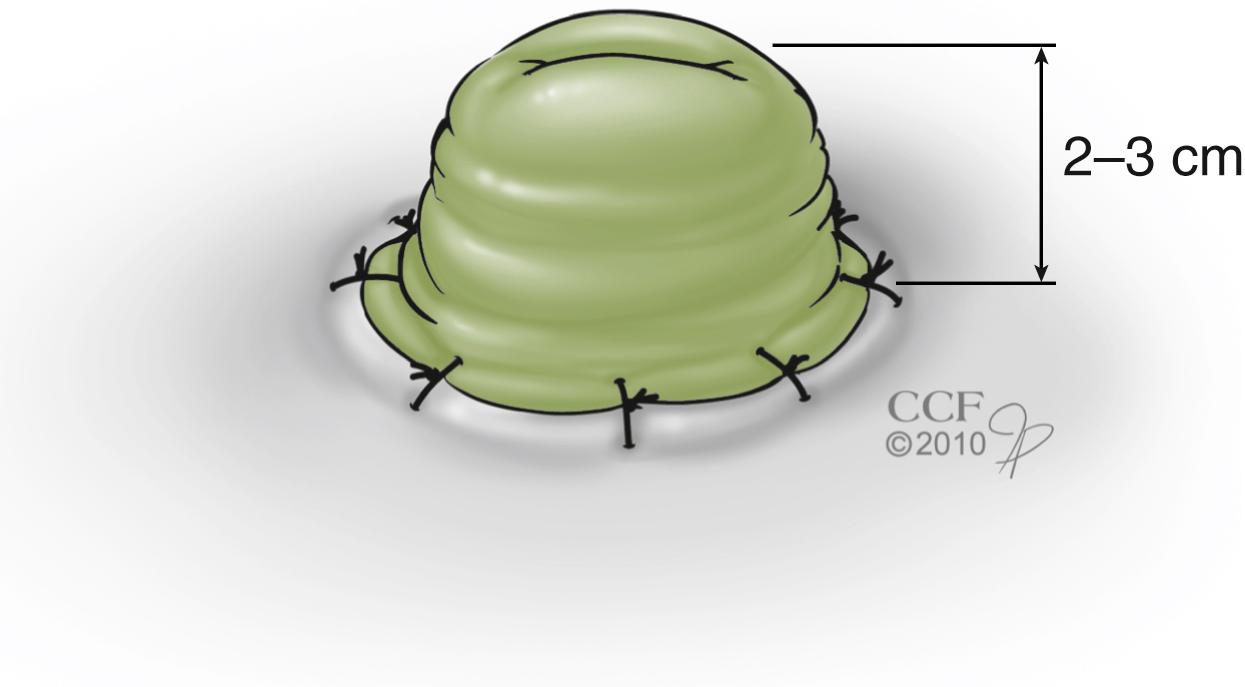 Fig. 59.3, Matured End Ileostomy.