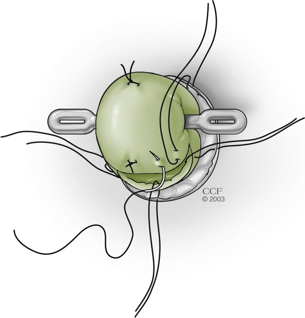 Fig. 59.5, Maturation of a Loop Ileostomy.