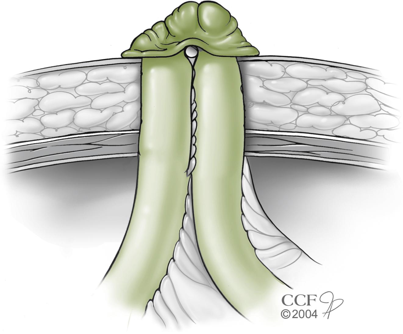 Fig. 59.6, Matured Loop Ileostomy.