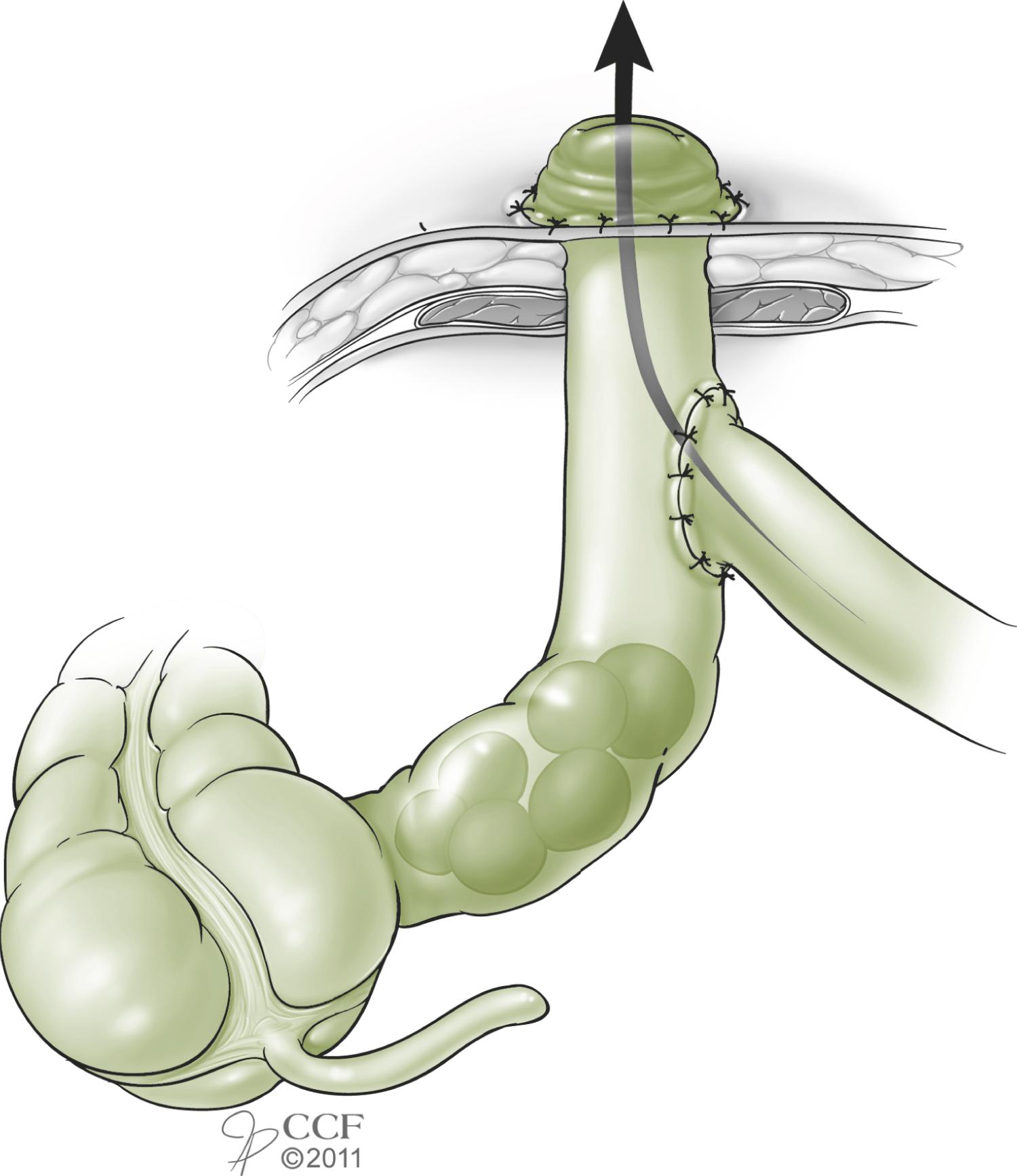 Fig. 59.7, Bishop-Koop Ileostomy.