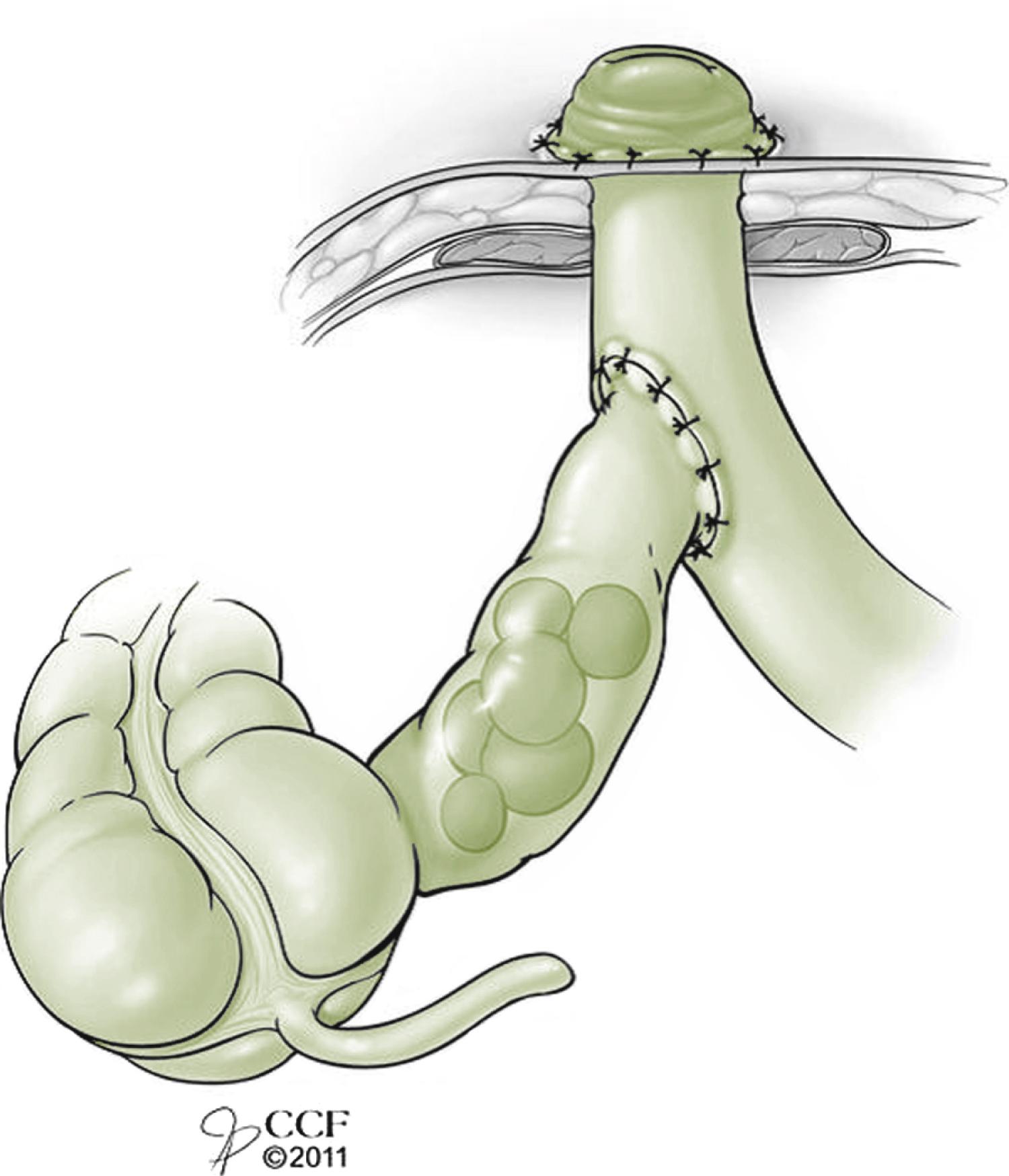 Fig. 59.8, Santulli Ileostomy.