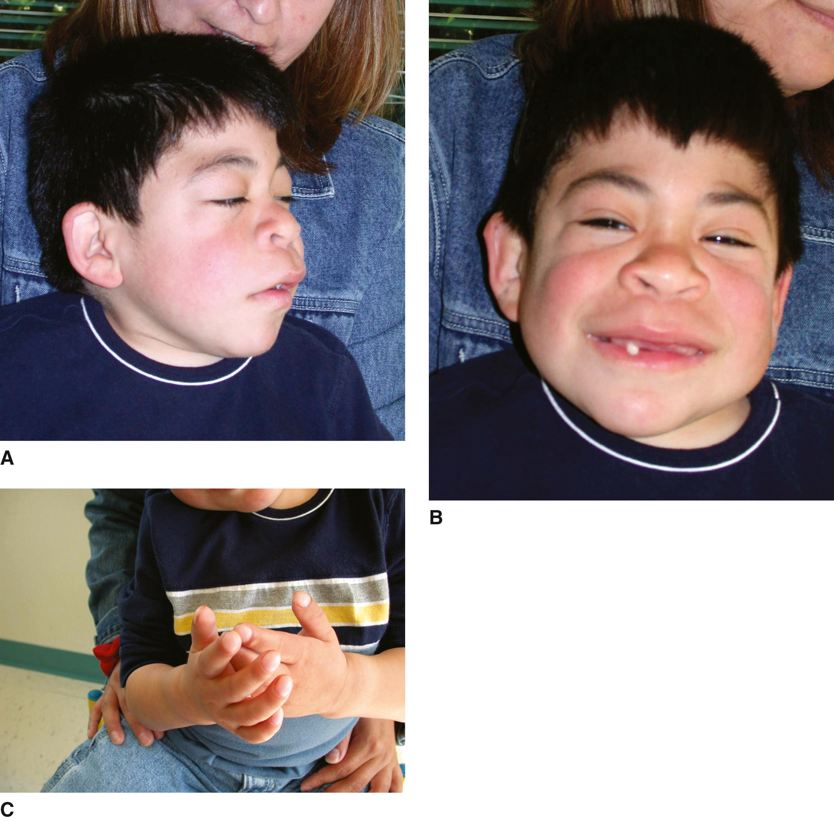 FIGURE 1, Leroy I-cell syndrome.