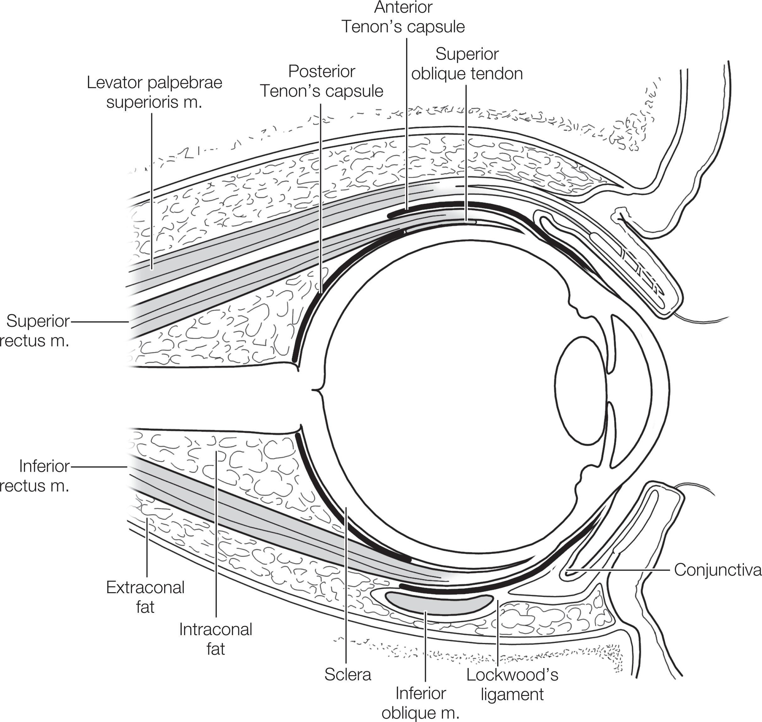 Fig. 88.1, Relationship of orbital fat to Tenon’s capsule and other structures. Violation of the posterior portions of Tenon’s capsule can result in protrusion of orbital fat into the surgical space.