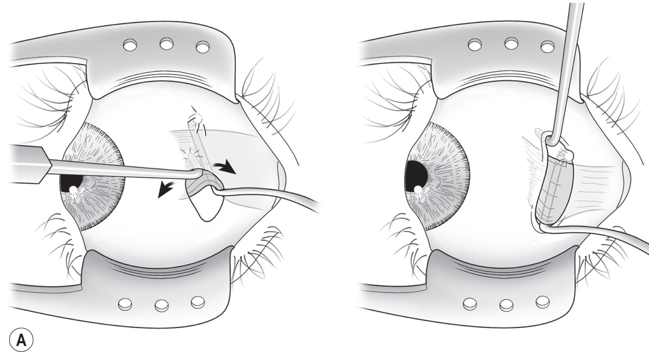 Fig. 88.13, Exposure of a rectus muscle insertion. (A) A small hook is used to slowly retract the conjunctiva over the muscle insertion while simultaneously rotating the muscle insertion into the incision. (B) The intermuscular septum is grasped with a pair of toothed forceps and incised, exposing underlying bare sclera.