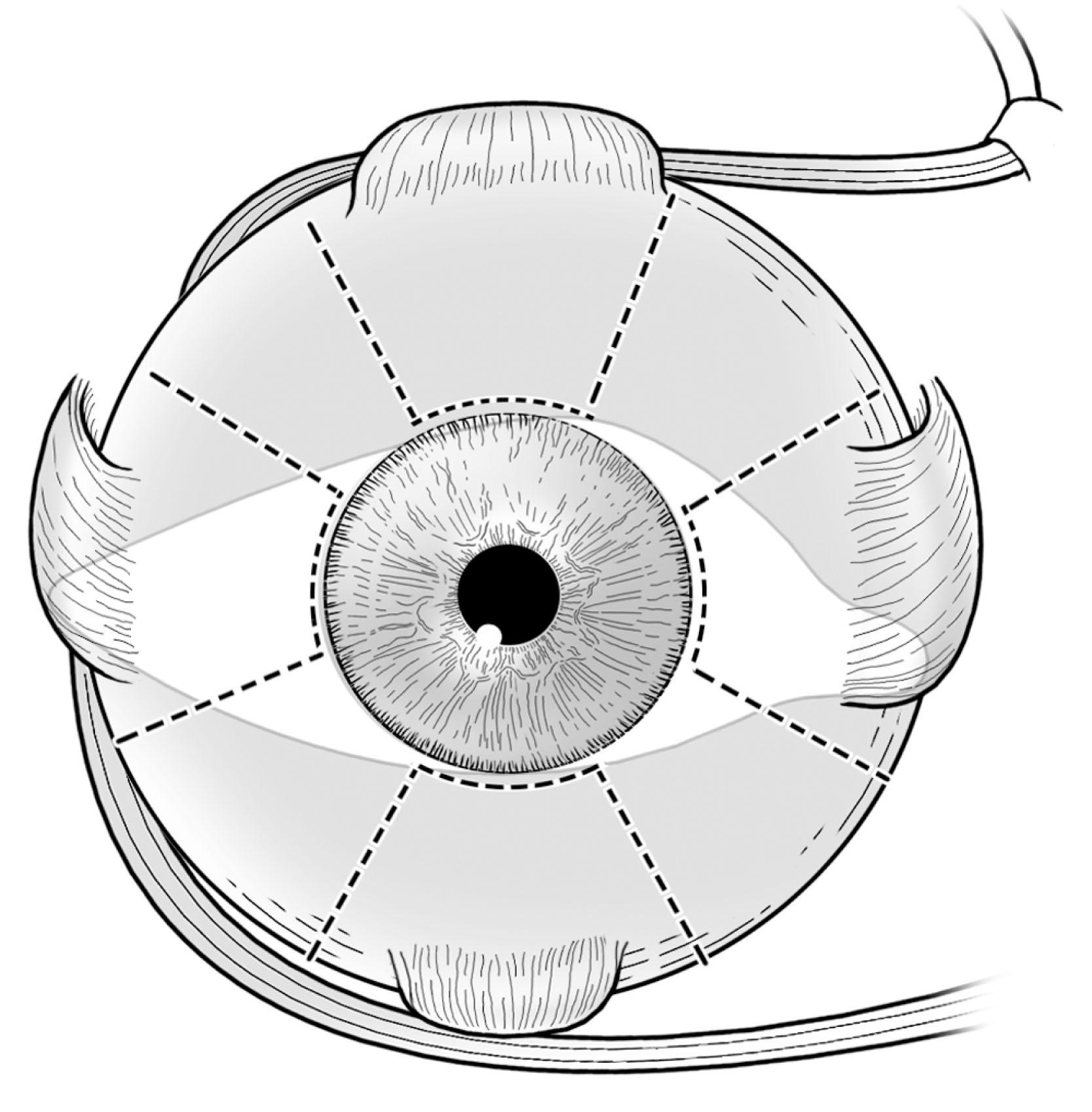 Fig. 88.15, Position of limbal incisions for surgery on the rectus muscles.