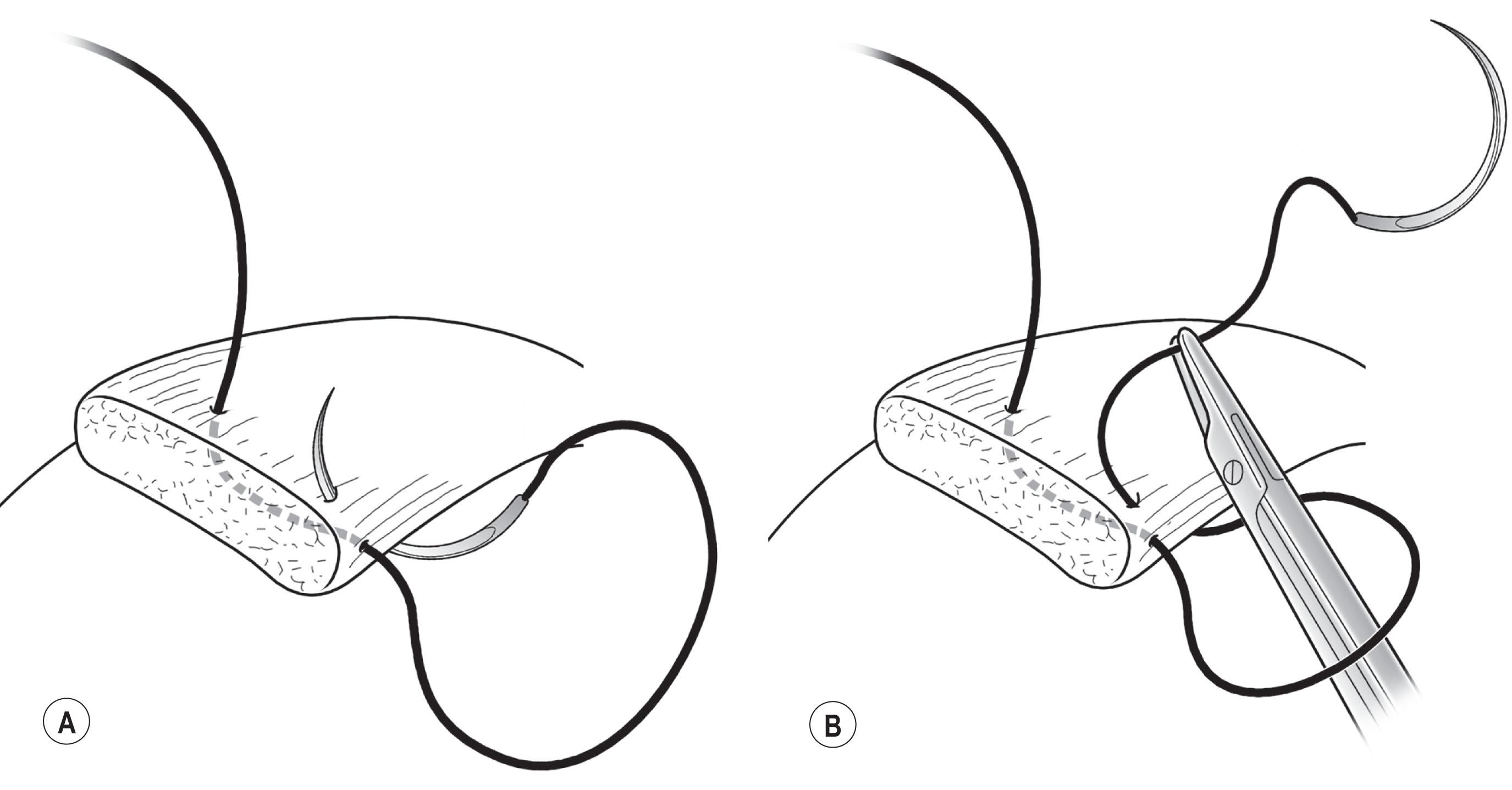 Fig. 88.19, Locking suture pass. (A) The suture is passed full-thickness through the muscle posterior to the transverse pass and around nearby anterior ciliary vessels. The locking bite should be at least 1 mm in width. (B) Completion of the locking bite.