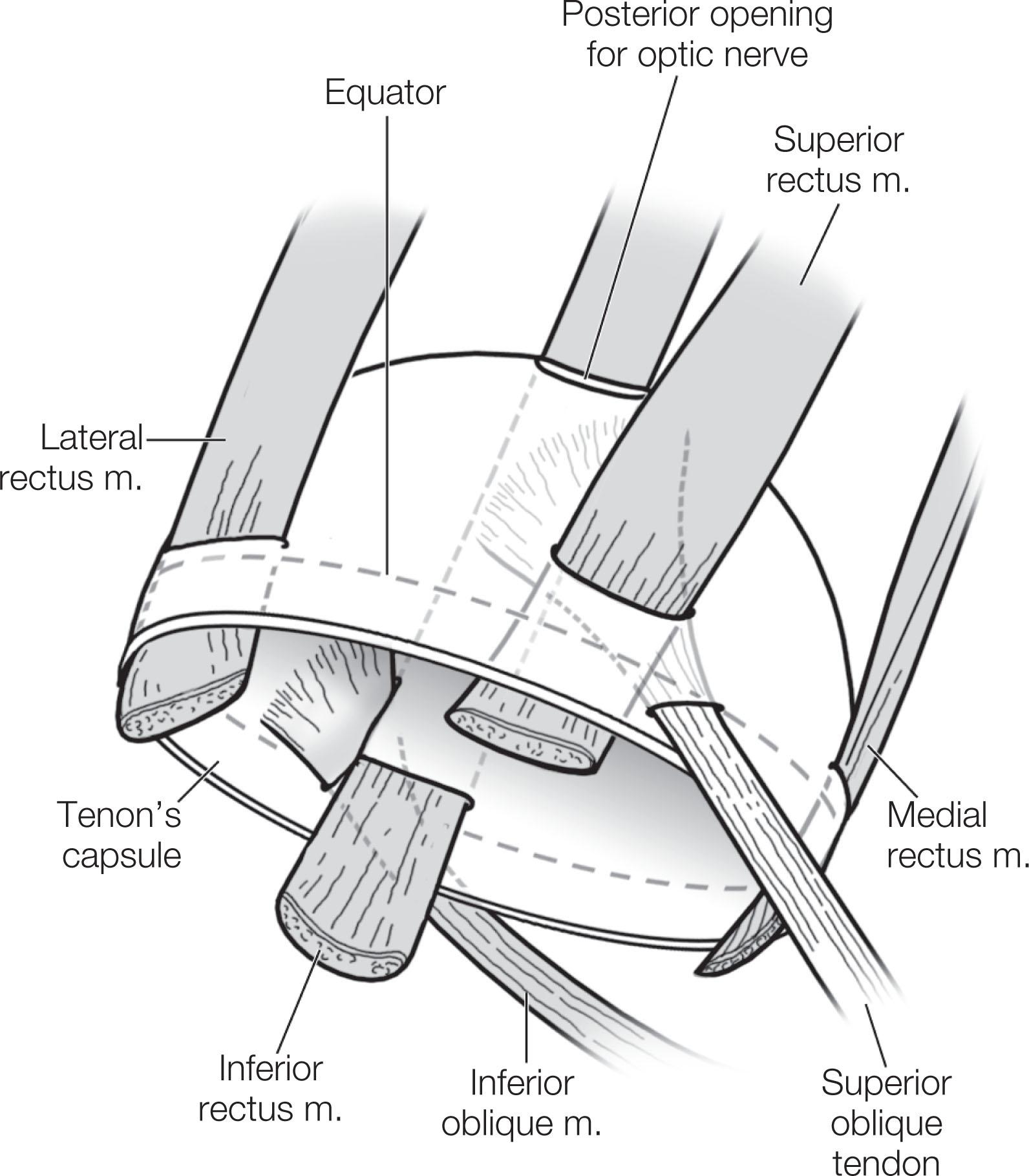 Fig. 88.2, Diagrammatic representation of Tenon’s capsule and relationship to the extraocular muscles. Note that the rectus muscles are located external to Tenon’s capsule posteriorly. They penetrate Tenon’s capsule to enter the episcleral space, then course anteriorly to insert on the sclera. The inferior oblique muscle and superior oblique tendon enter the episcleral space anteriorly and course posteriorly to insert on the sclera. The rectus muscle pulleys, muscle capsule, and intermuscular capsule are not represented in this diagram.