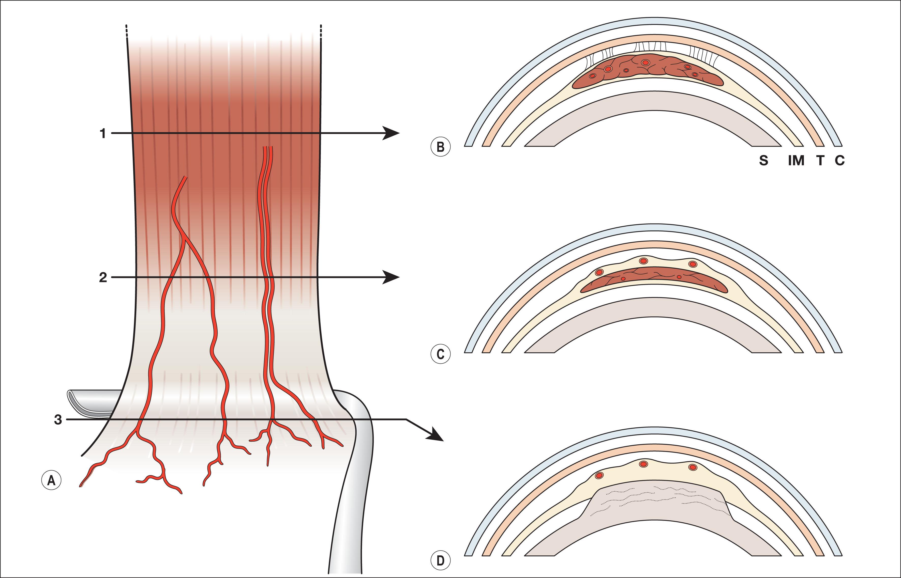 Fig. 88.3, Diagram of typical rectus muscle showing position of anterior ciliary vessels (ACVs). (A) Surgeon’s view of inferior rectus. The ACVs emerge from the substance of the muscle, posterior to the transition from muscle to tendon. Anterior to this point, the ACVs travel on the surface of the muscle and tendon, following a somewhat serpentine course in a plane that is continuous with the muscle capsule, continuing onto the surface of the sclera. (B) Transverse section of rectus muscle at position A-1, posterior to the point of emergence of the ACVs. The vessels are deep in the muscle, not visible to the surgeon. C, conjunctiva; IM, intermuscular septum (continuous with the muscle capsule); S, sclera; T, Tenon’s capsule. (C) Transverse section at position A-2 showing three ACV “groups” on the surface of the tendon, in a plane that is continuous with the capsule of the muscle and tendon. Each anterior ciliary vessel group can contain more than one anterior ciliary vessel. (D) Transverse section at position A-3: the tendon insertion site. The ACVs remain on the surface and continue onto the sclera, anterior to the tendon insertion.