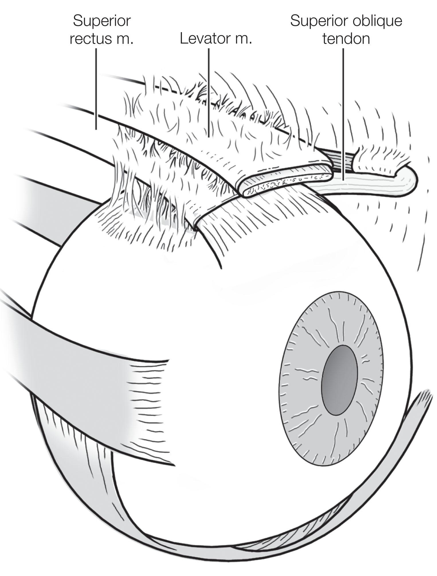 Fig. 88.7, Complex sheath of the superior oblique tendon. Note tenuous attachments to the sheath of the superior rectus muscle and to the levator muscle.