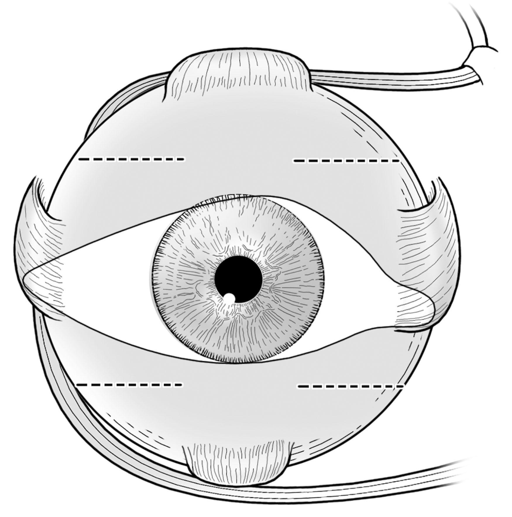 Fig. 88.10, Potential locations for placement of a fornix incision for rectus muscle surgery. Incisions placed in the lower quadrants are preferred, when possible.