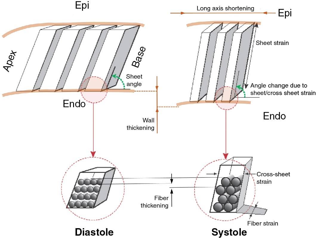 Fig. 7.1, Basics of myocardial structure and mechanics. (Left panels) Diastole: myocytes are grouped in muscle sheets similar to the way the logs are arranged in a log rack, with approximately four myocytes per sheet thickness. The muscle sheets then traverse from the epicardium to endocardium in an oblique angle when referenced to the endocardial surface. (Right panels) Systole: during systole, myocytes become shorter in length (i.e., have negative fiber strain) while thickening in cross section). This fiber cross-sectional thickening forces myocytes to rearrange themselves within the muscle sheets, which leads to cross-sheet thinning (negative cross-sheet strain), sheet lengthening (positive sheet strain), and in sheet angle alteration. The fiber deformation, sheet deformation, and sheet angle alteration each contribute to circumferential, longitudinal, and radial strain, albeit at a different degree. Sheet extension and alterations in sheet angle are the main determinants of wall thickening (radial strain). Sheet angle change and cross-sheet thinning lead to long and short axis shortening (longitudinal and circumferential strain).