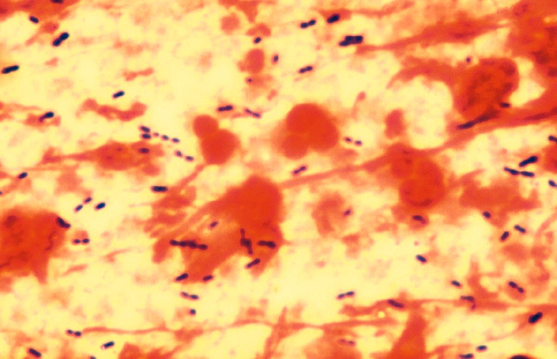 FIGURE 268-1, Gram stain of sputum from patient with pneumococcal pneumonia showing gram-positive diplococci aligned end to end.