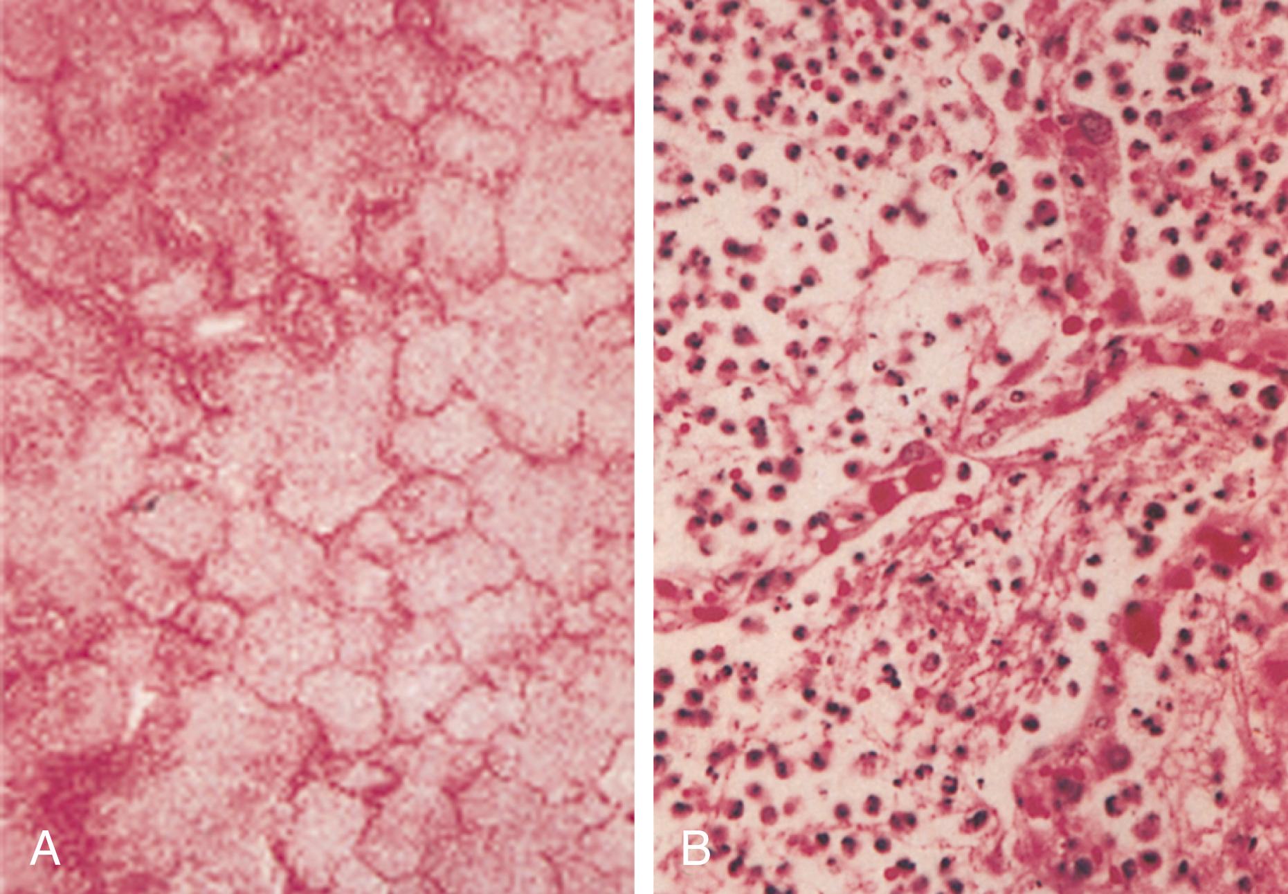 FIGURE 268-2, Pneumonia.