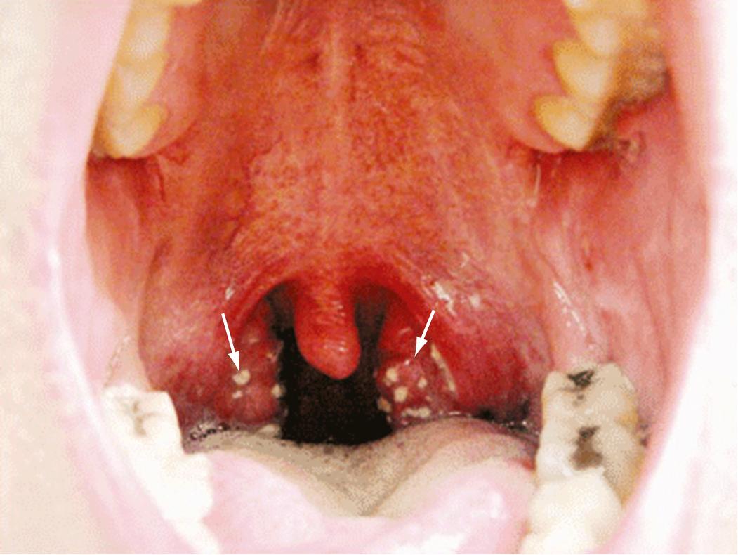 FIG. 197.3, Streptococcal tonsillopharyngitis.