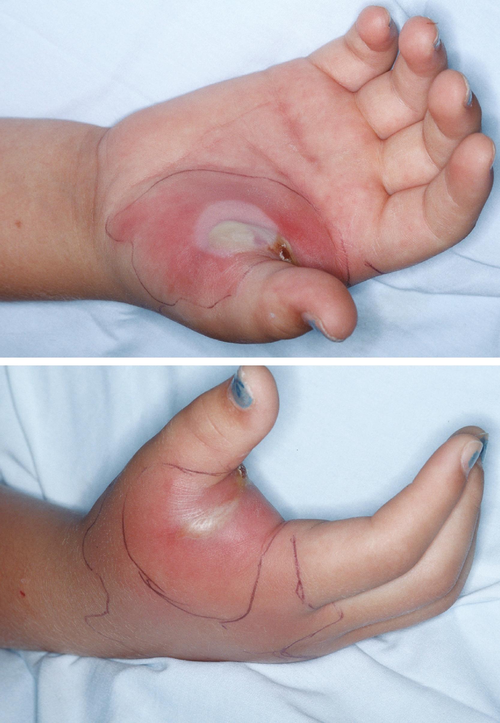 FIGURE 118.2, Young girl with bullous, invasive local infection without trauma or foreign body; the infection was caused by group A Streptococcus .