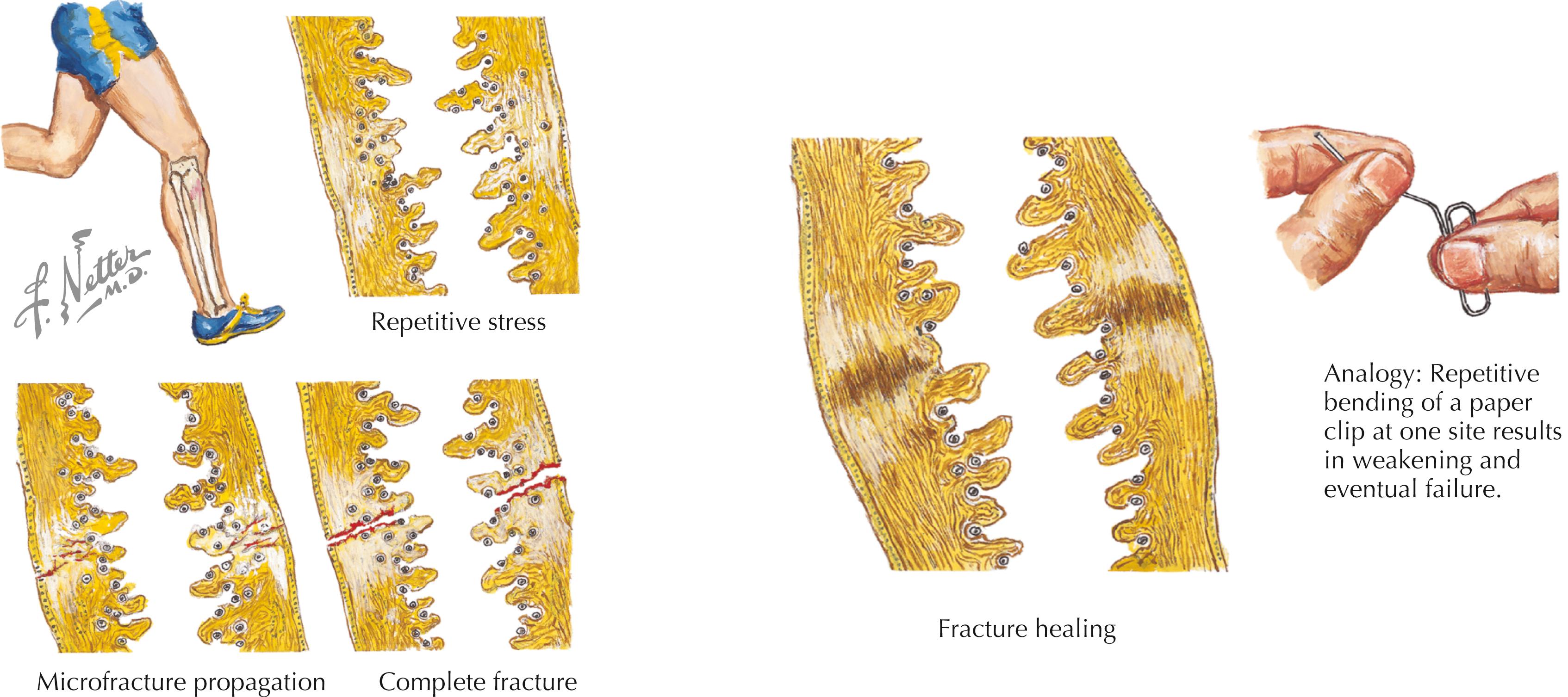 Figure 59.1, Etiology of stress fracture. Site specificity of stress fractures in track and field athletes is determined by the anatomic stress demanded by the sport.