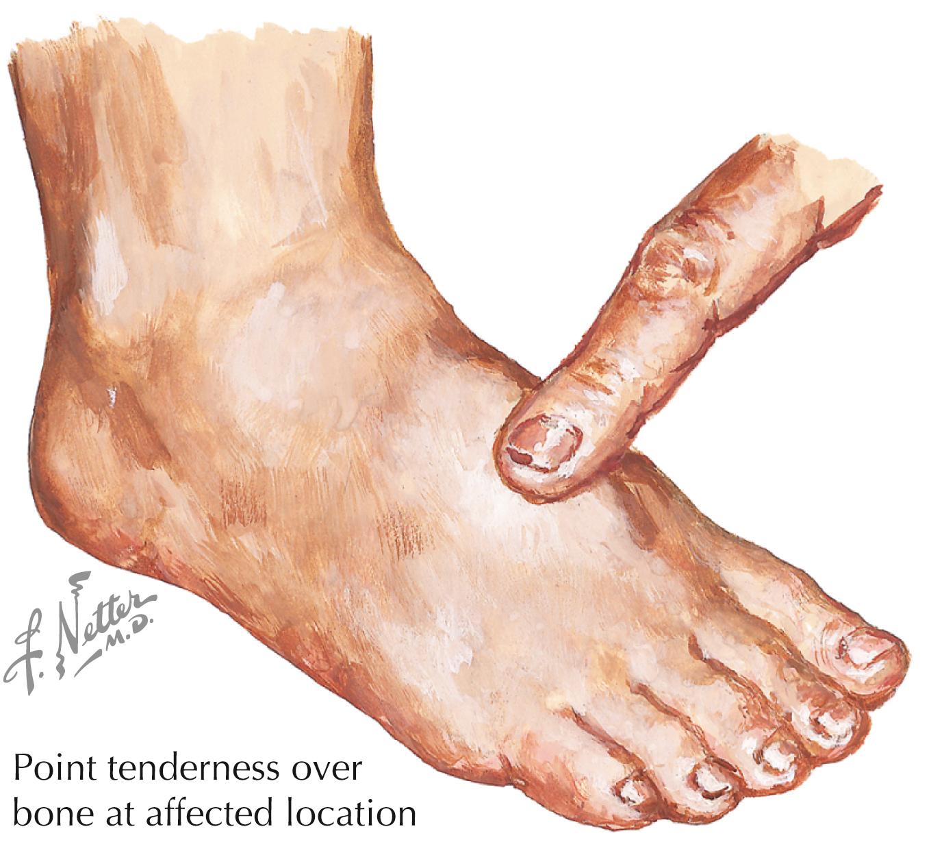 Figure 59.3, Physical examination of stress fracture.