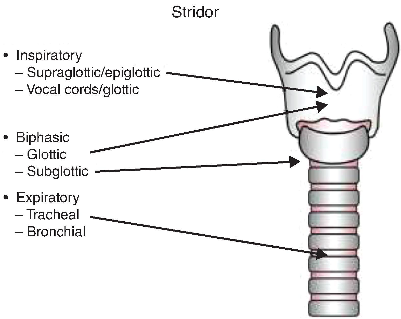 Fig. 67.1, Depiction of Laryngotracheal Anatomic Sites Related to Stridor .