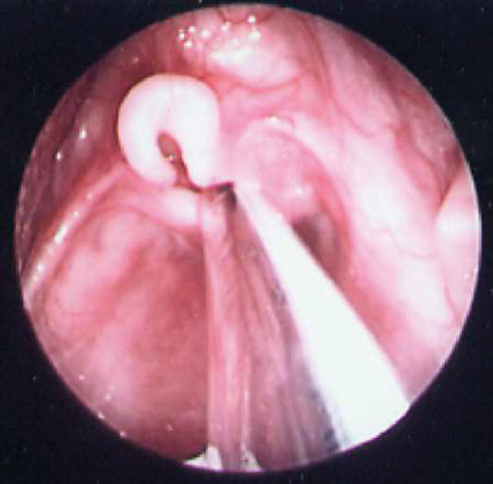 Fig. 67.2, Laryngomalacia .