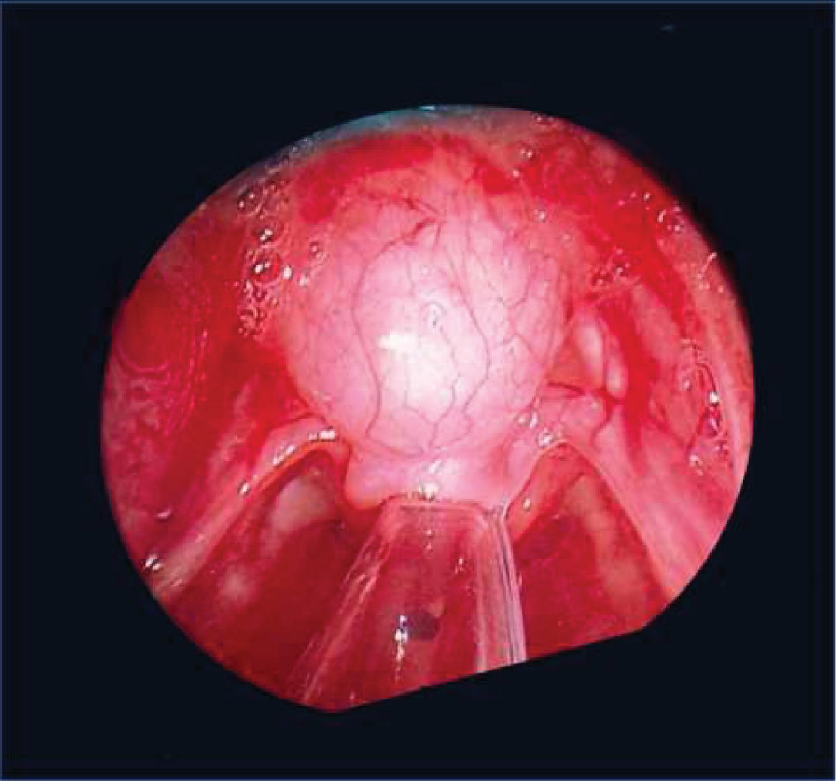 Fig. 67.3, Vallecular Cyst Causing Posterior Displacement of the Epiglottis .