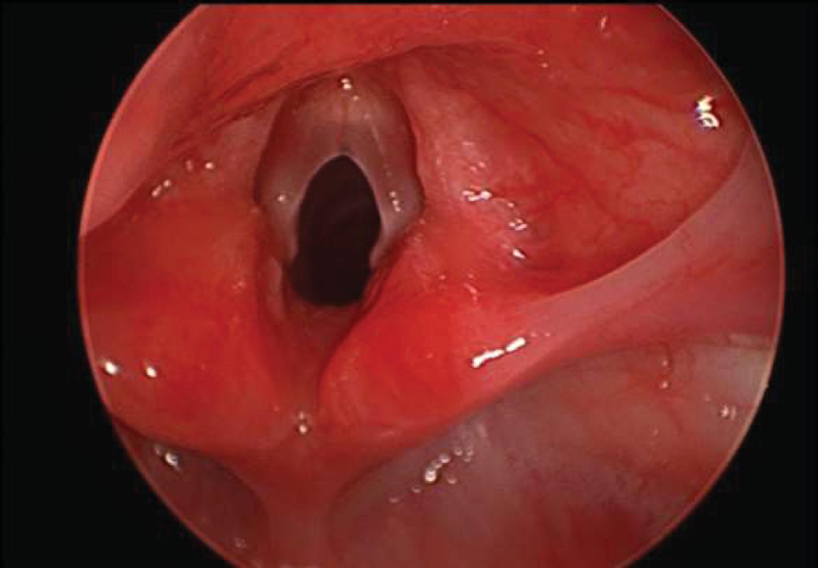 Fig. 67.4, Congenital Anterior Glottic Web .