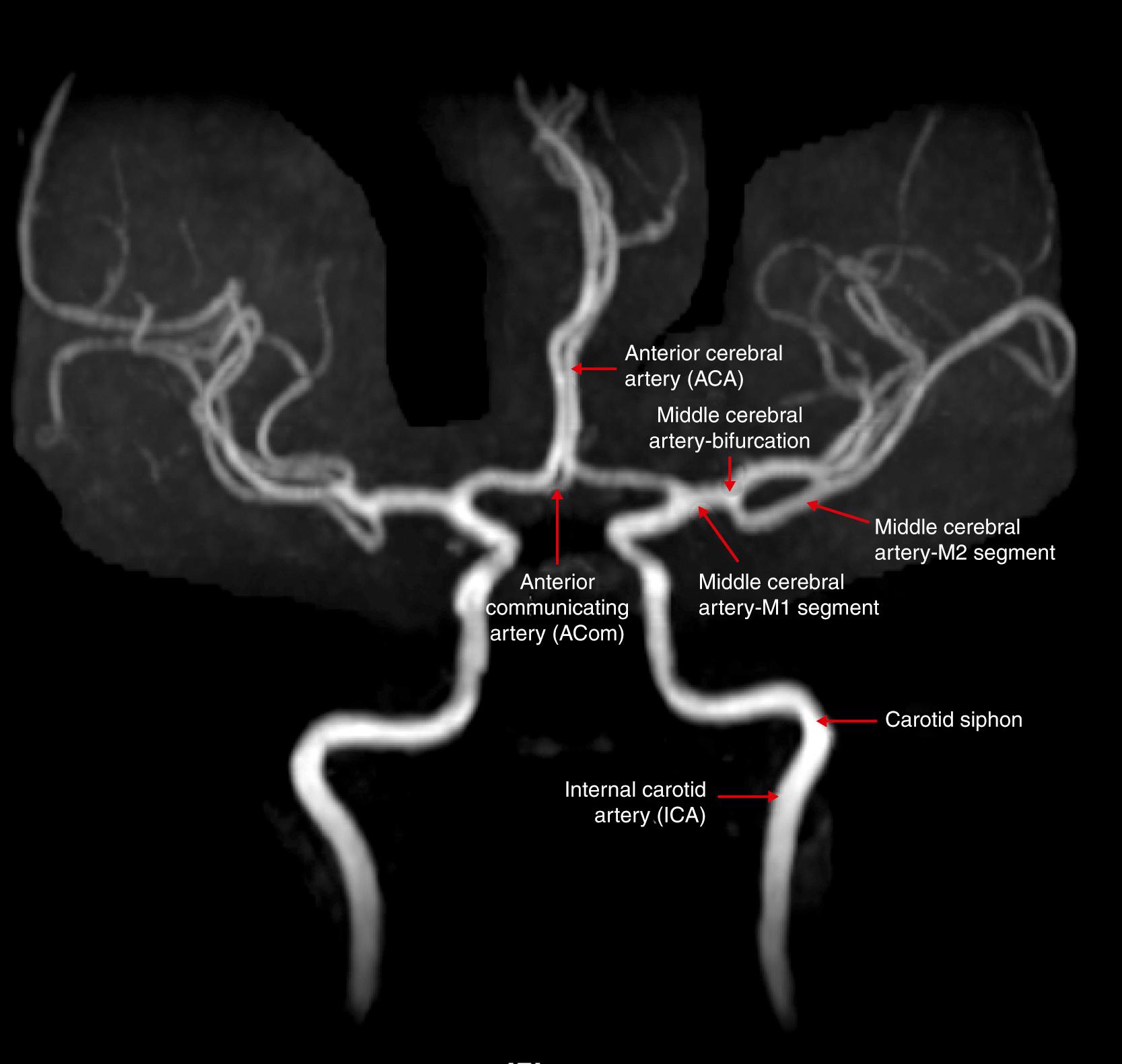 Fig. 37.1, Magnetic resonance angiogram of the intracranial portion of the internal carotid artery and its main branches.