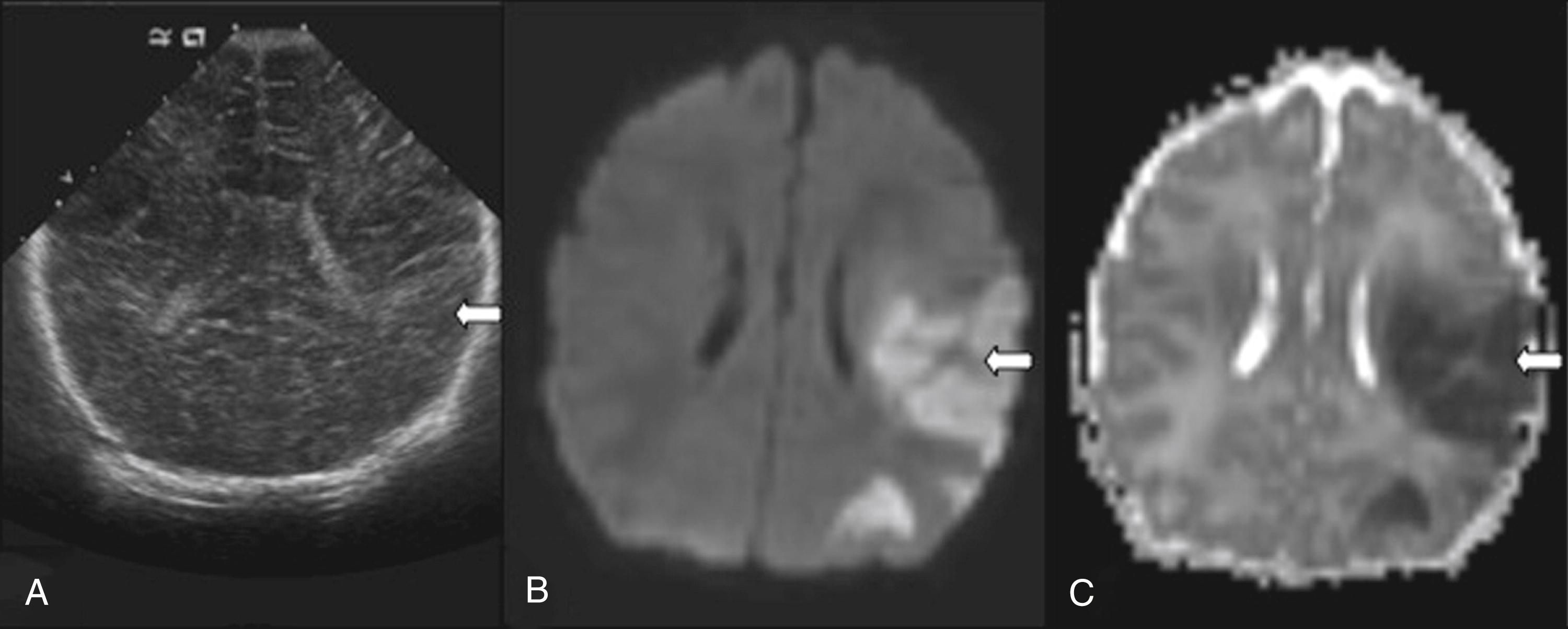Fig. 37.11, Neonatal arterial ischemic stroke. Ultrasound (US) and MRI of neonatal arterial ischemic stroke in a 1-day-old term infant who presented with a right focal seizure. A, US reveals hyperechogenicity in the left cerebral hemisphere (indicated by white arrow ), concerning for ischemic injury. B, Axial MRI diffusion-weighted trace image of the same patient reveals well-defined hyperintensity (indicated by white arrow ) in the left middle cerebral artery (MCA) territory. C, Apparent diffusion coefficient map of the matching slice observed in (B) reveals corresponding hypointensity (indicated by white arrow ) in the left MCA territory.