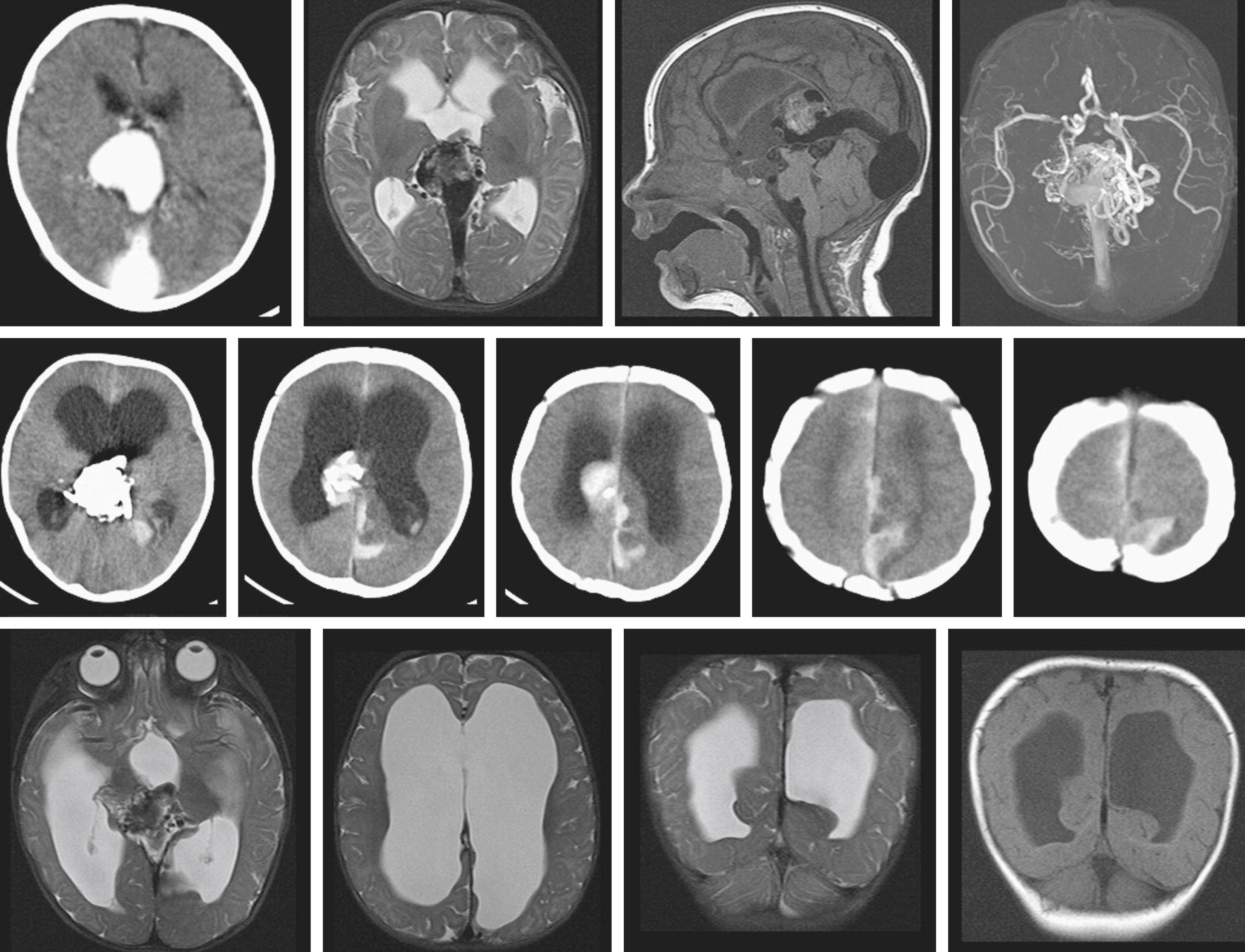 Fig. 37.12, Neonatal vein of Galen malformation and intraventricular hemorrhage. A 5-day-old female born at 38 weeks was noted to be drowsy with poor feeding. She had signs of cardiac failure. A CT scan (top left) demonstrates vein of Galen aneurysmal malformation, which was partly treated by transarterial glue embolization without complication but with significant residual arteriovenous shunting (MR images, top row ). Following a second embolization procedure, there was acute clinical deterioration with signs of raised intracranial pressure (middle row) . CT shows acute intraventricular hemorrhage and hydrocephalus, and a left parieto-occipital lobe low-density lesion ( middle , images 1–3) with adjacent subarachnoid and subdural hematoma ( middle , images 4 and 5). Some linear hyperdensity was believed to be due to thrombus within the persistent falcine sinus ( middle , images 4 and 5). Follow-up imaging shows maturation of the focal left parieto-occipital lesion in keeping with an infarct (bottom row) , which is probably venous in origin.