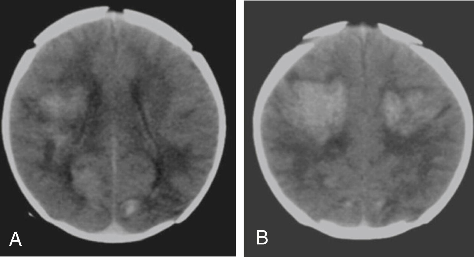 Fig. 37.13, Neonatal intraventricular and intraparenchymal hemorrhages. A term baby delivered by cesarean section for thick meconium and late decelerations, Apgar scores of 1, 6, and 8 (at 1, 5, and 10 minutes), presented with neonatal seizures on the first day of life. A and B , Axial head CT images show bilateral frontal, parietal, and scattered occipital hemorrhages in the periventricular and subcortical white matter, the largest in the frontal centrum semiovale.