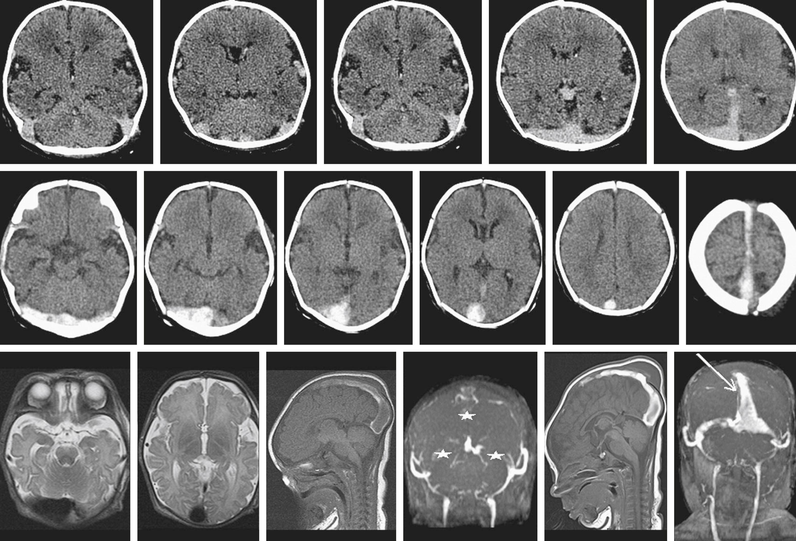 Fig. 37.14, Neonatal cerebral sinovenous thrombosis. A term male neonate was hypotonic at birth with poor respiratory effort requiring resuscitation. Initial CT (top row) on day 2 of life shows diffuse brain edema with expanded and hyperdense transverse and sagittal sinuses, torcula, and internal cerebral veins as well as the cerebral cortical veins. CT performed on day 9 (middle row) shows resolution of the cerebral edema and increased density of the thrombus within the transverse sinus, torcula, and superior sagittal sinus. MRI on day 9 (bottom left, images 1–4) shows mild diffuse cerebral atrophy but no focal venous infarcts, with a persistent thrombus and no flow on the magnetic resonance venography (stars) . Follow-up MRI on day 15 ( bottom right , images 5 and 6) shows the evolution of thrombus signal intensity to methemoglobin. Note the effect of T1 shortening within the thrombosed sagittal and transverse sinuses and torcula, mimicking flow within the sinuses (arrow).