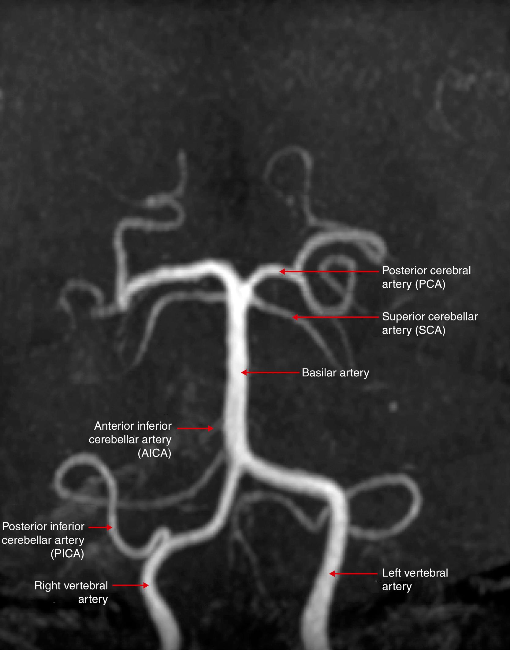 Fig. 37.2, Magnetic resonance angiogram of the intracranial portion of the vertebrobasilar system.