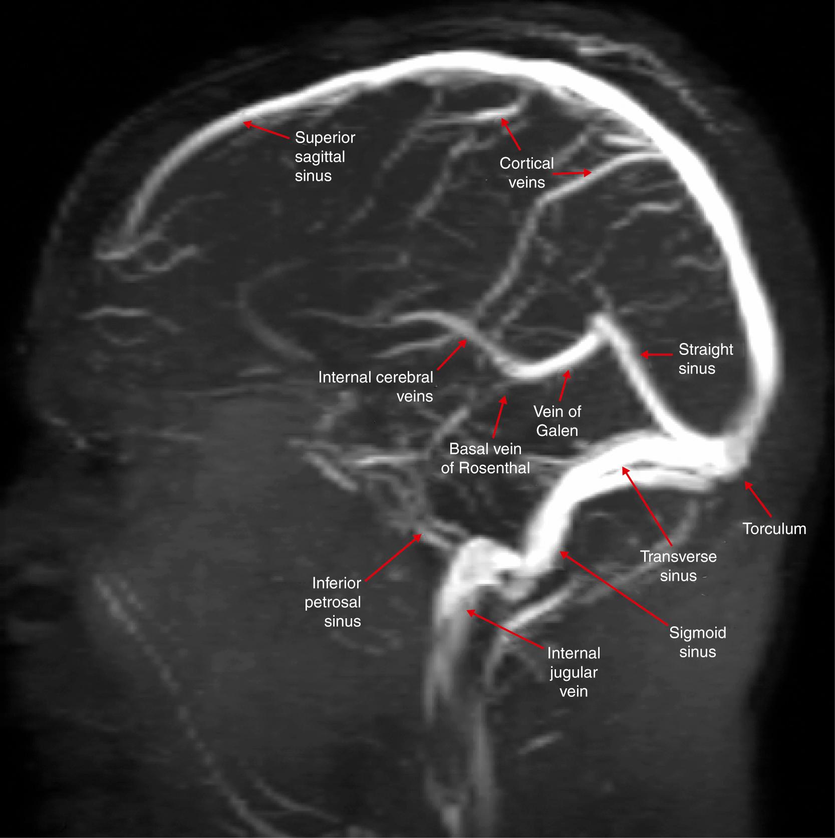 Fig. 37.5, Parasagittal magnetic resonance venogram showing venous structures.