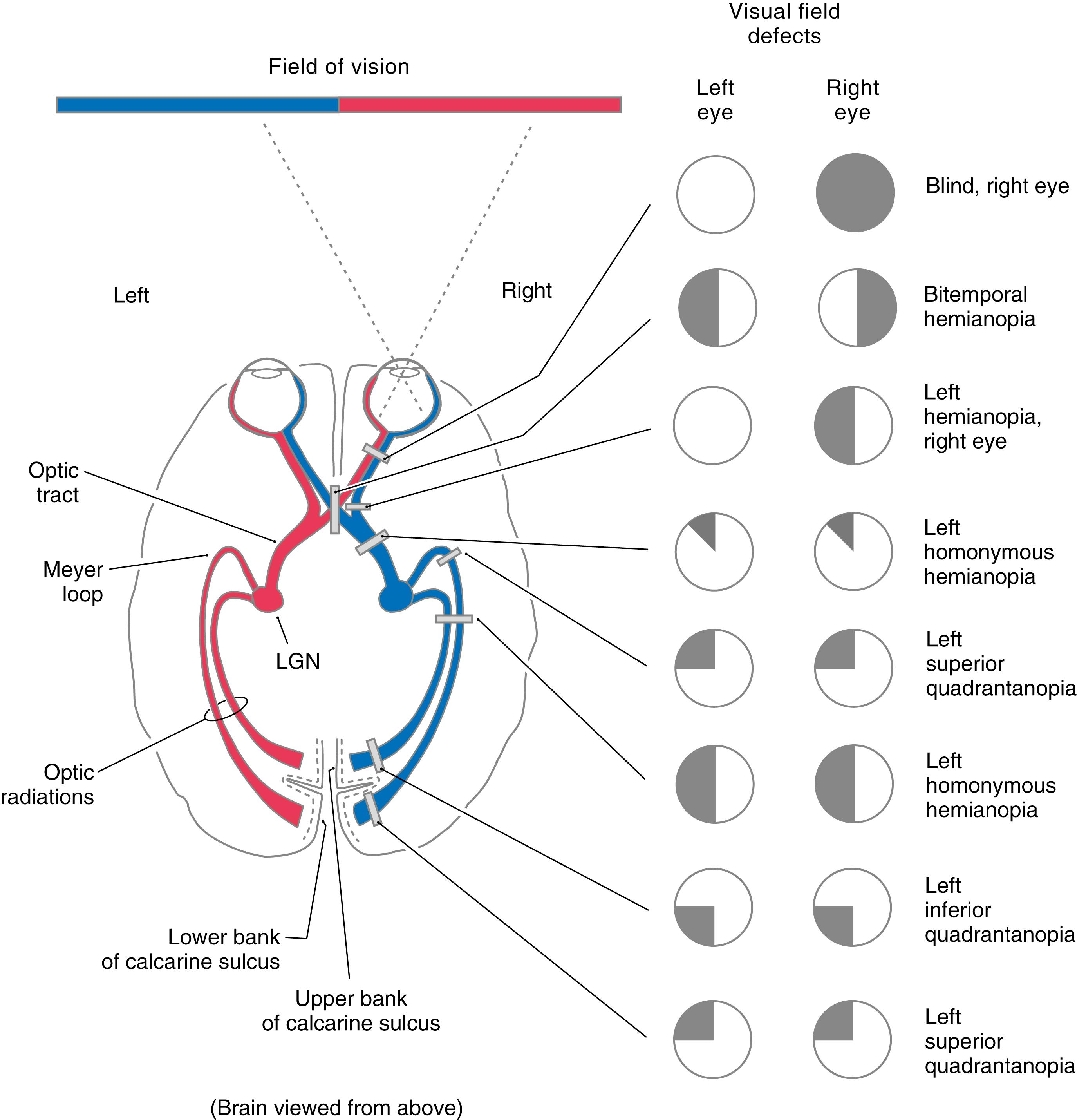 Fig. 37.8, Visual field defects produced by lesions as different places in the visual pathway. Regions of normal vision are indicated in white ; regions of loss of vision are indicated in black . LGN, lateral geniculate nucleus.