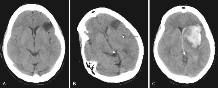 Figure 61-1, Hemorrhagic infarct and not primary intracerebral hemorrhage.