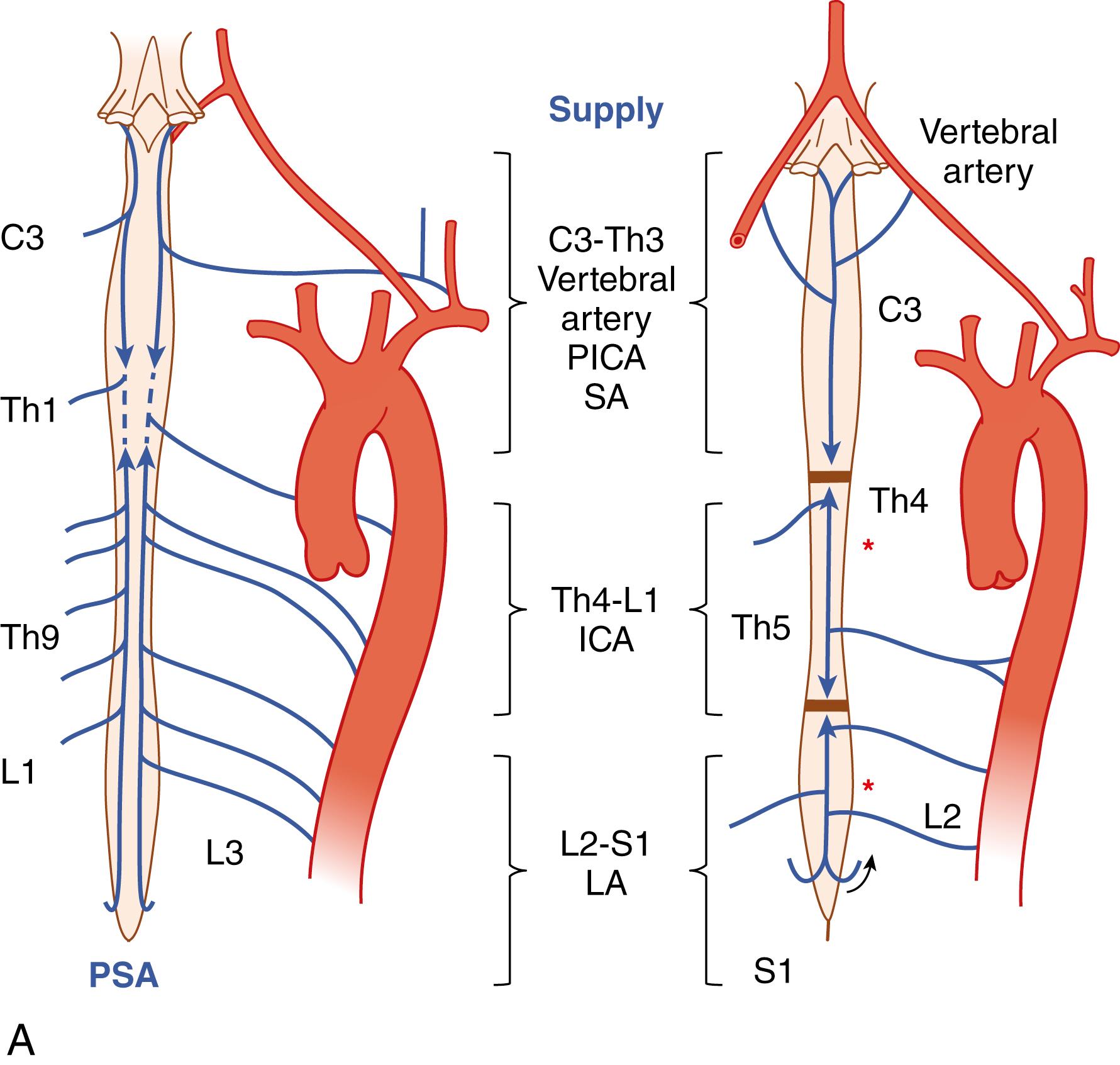 Fig. 31.4, (A) Blood supply to the spinal cord. Δ , Iliopsoas muscle. X , paraspinous muscular vasculature providing extensive longitudinal arterio-arteriolar connections; ≫, anterior spinal artery. (B) Anatomy of the collateral network: sagittal (B1) and dorsal (B2) view. The macroscopic appearance of casts of a pair of dorsal segmental vessels at L1. The dorsal process is removed. Asterisks indicate paraspinal muscle arterial supply. (C) Relationship of anterior spinal artery (ASA) and repetitive epidural arcades dorsal view into the opened spinal canal showing the dorsal surface of two vertebral bodies. The spinal cord is removed to clarify the anatomic location of the epidural circular arcades and ASA. V , Epidural venous plexus. Anterior to the extensive venous plexus, four arteriolar branches (yellow arrows) contribute to one circular epidural arcade. This pattern is repeated at the level of each vertebral segment. These vascular structures connect the segments side to side as well as longitudinally. They connect with the main stems of the segmental arteries and can therefore be considered to contribute indirectly to the ASA. Green arrows designate the anterior radiculomedullary artery, which connects directly with the anterior spinal artery.