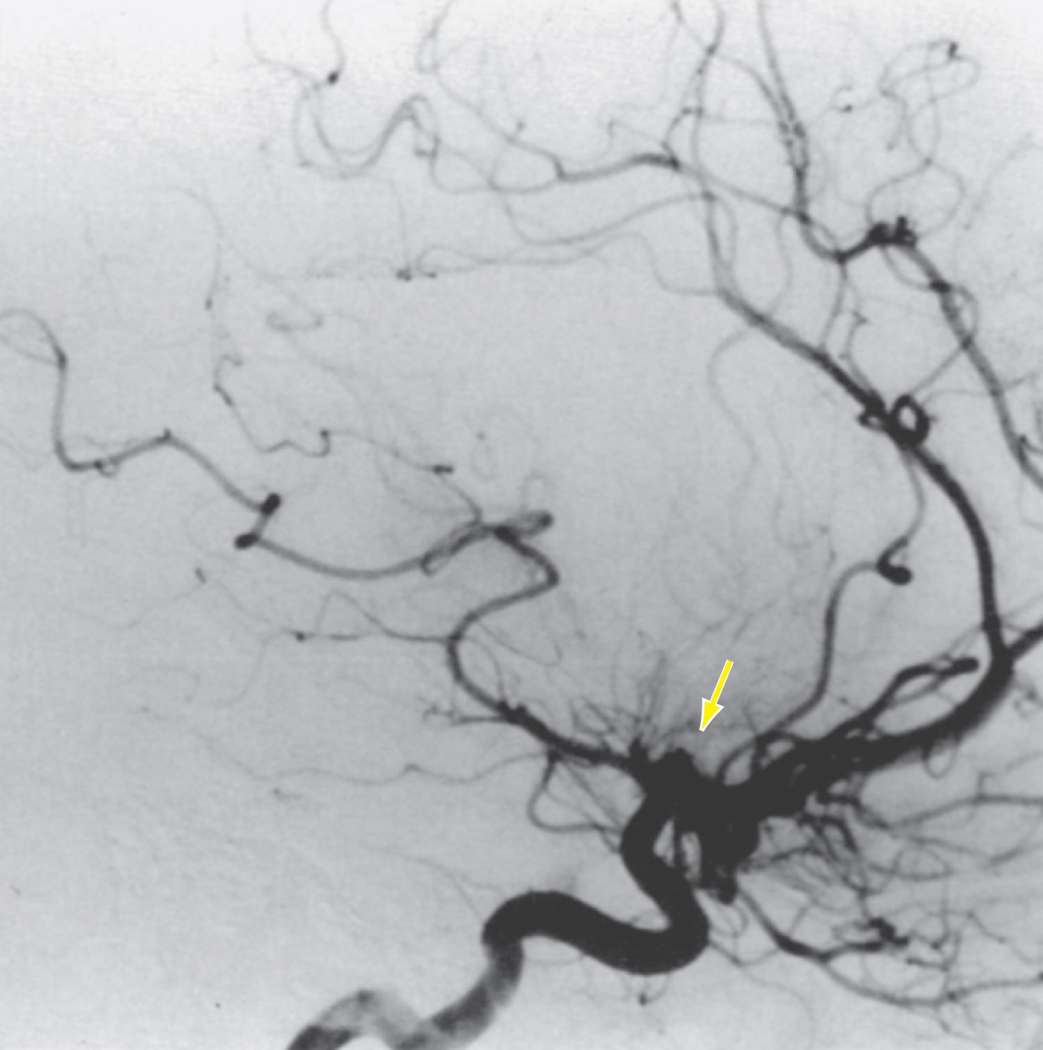 Figure 11-1, Angiogram showing a middle cerebral artery occlusion ( arrow ) in a young woman with anticardiolipin antibodies, the lupus anticoagulant, and myxomatous mitral valve thickening.