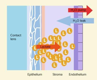 Fig. 22.11, Aetiology of contact lens–induced oedema. Excess lactate in the stroma resulting from anaerobic respiration of the epithelium draws water osmotically into the stroma.