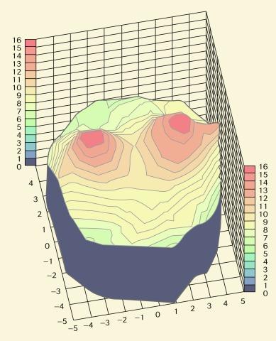 Fig. 22.3, Three-dimensional representation of topographical corneal oedema response to wear of conventional mid-water-content hydrogel lenses under closed-eye conditions. To the right is the nasal direction, and the closer region is the inferior cornea. The vertical scale is the percentage increase in corneal thickness over baseline.