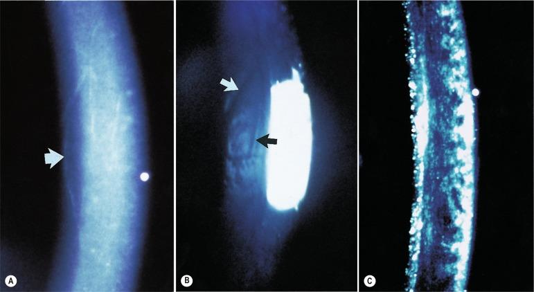 Fig. 22.4, Slit lamp photographs depicting corneal signs of increasing oedema from left to right. (A) Striae – a vertical striate line (arrow) can be observed in the posterior stroma in direct focal illumination. (B) Folds – a depressed groove (white arrow) and raised ridge (black arrow) observed in specular reflection. (C) Haze – the stroma takes on a granular appearance at high levels of oedema as viewed in direct focal illumination.